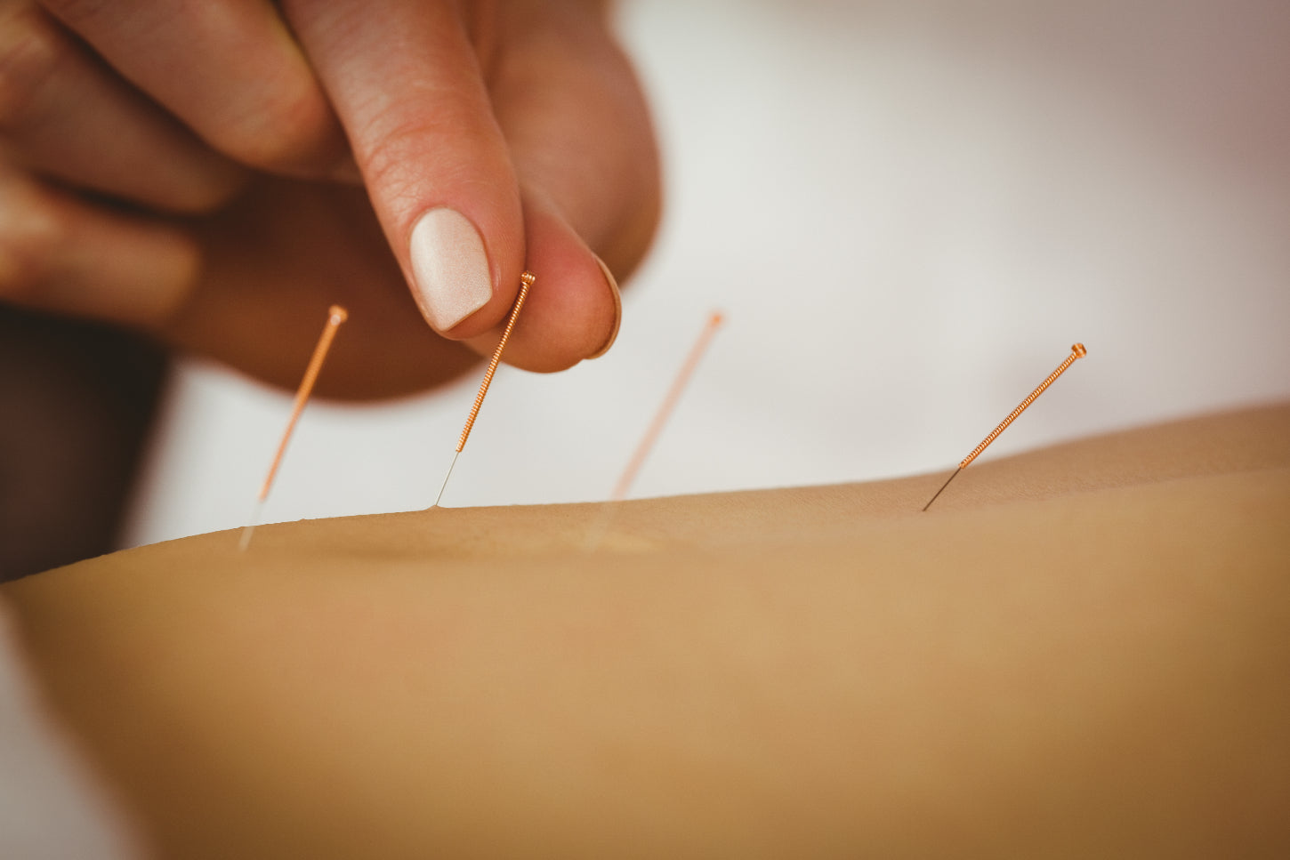 young woman getting acupuncture vs massage by professional